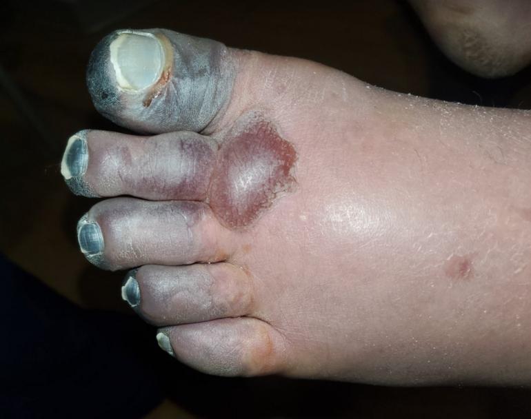 Frostbitten Feet