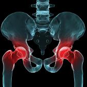 hip, orthopedic surgery, hip injuries